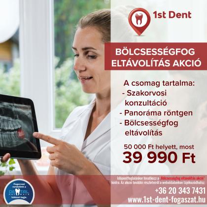 Bölcsességfog eltávolítás akció